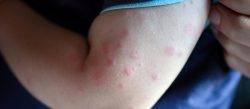Child with hives on his arm.